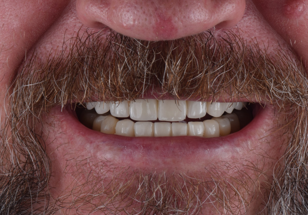 0 - Dentistas em Porto Alegre - Especialista em Implantes Dentários em Porto Alegre - Doutor Roberto Suzuki - Dentes em POA - img 01